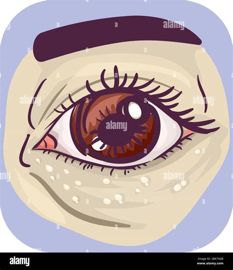 Illustration of Milia, White Bump Skin Under the Eye Stock Photo - Alamy