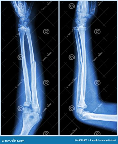 Fracture Shaft of Ulnar Bone ( Forearm Bone ) : ( Front and Side View ...