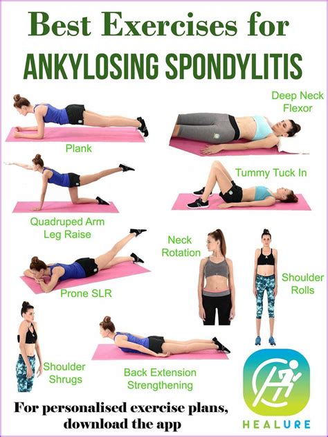 ankylosing spondylitis