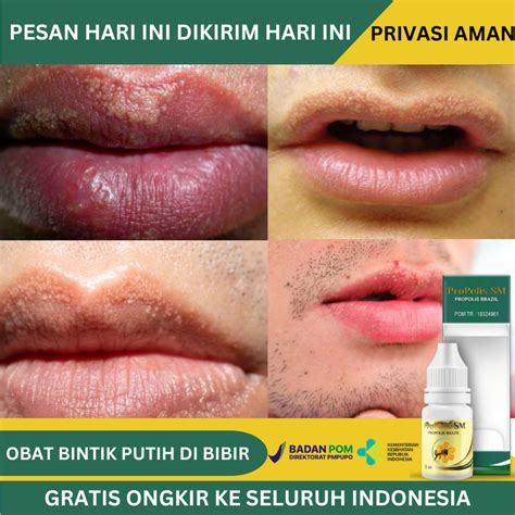 Jual Obat Oles Penghilang Bintik Putih Di Bibir, Obat Bercak Putih Di Bibir, Obat Fordyce Spots ...