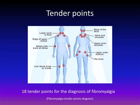 Fibromyalgia powerpoint completed | PPTX