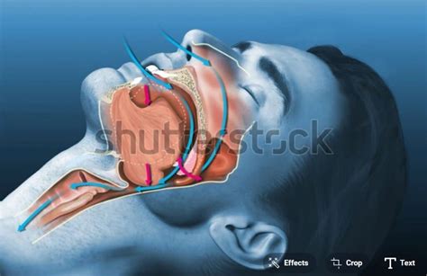 Image result for Obstructive Sleep Apnea