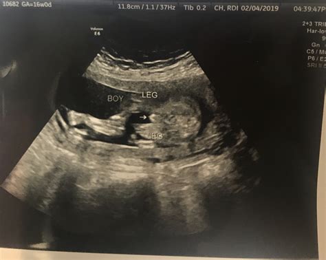 boy gender ultrasound - hiccups pregnancy