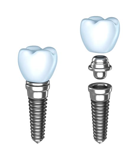 Implant Restoration | Dental Implant Restorations Chicago