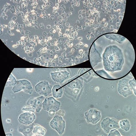 Squamous Epithelial Cells In Urine