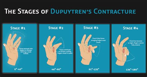 Dupuytren's contracture treatment - Philadelphia Holistic Clinic