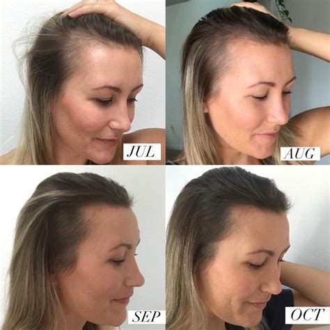 hair fall postpartum