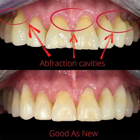 Understanding Tooth Sensitivity: Causes, Symptoms & Treatments