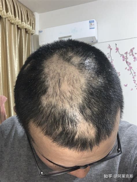 斑秃有哪几种类型_斑秃_北京京城皮肤医院(北京医保定点机构)