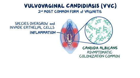 Video: Vulvovaginal candidiasis: Clinical sciences | Osmosis