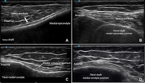 An update on radiofrequency denervation for arthritis-related knee ...