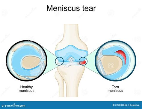 Meniscal Tear. Knee Anatomy Stock Vector - Illustration of health ...
