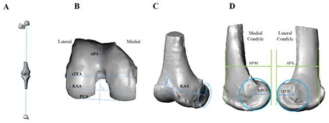 Lateral Condyle Femur