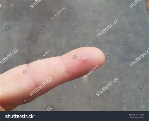 Splinter Finger 的图像结果