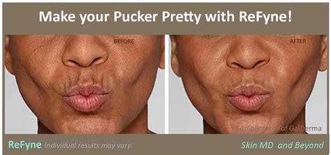 Image result for Restylane Refine