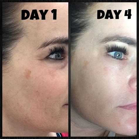 List 90+ Pictures Chemical Peels Before And After Pictures Stunning