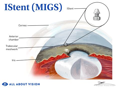 Glaucoma surgery: Types, benefits, risks and side effects