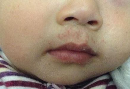 孩子嘴巴周围起红疹什么原因 孩子嘴巴周围起红疹预防方法 - QQ业务乐园