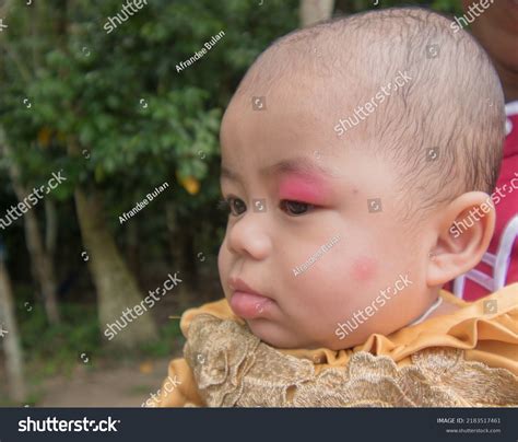 Little Baby Infection Eyelid Caused By Stock Photo 2183517461 ...