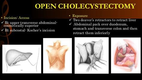 Open Cholecystectomy 的图像结果