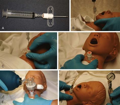 Anesthesia Airway Lavage 的图像结果