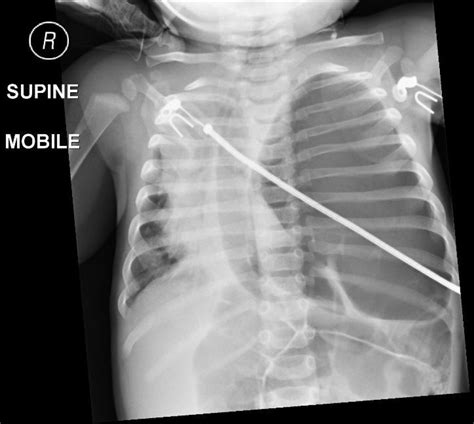 Congenital Diaphragmatic Hernia X Ray