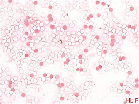 Image result for Fetal Bleed Screen Kit Parallel Testing