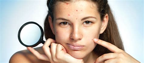 What Causes Acne On Cheeks And Forehead? – Re'equil