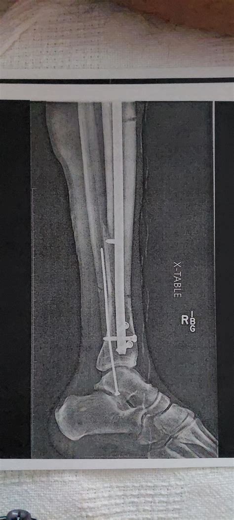 Image result for CVC Line Distal Port