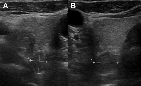 Parathyroid Ultrasound