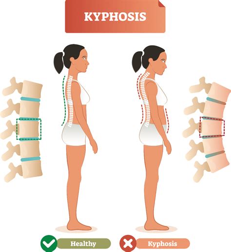 How to Treat Your Kyphosis: Exercises and Supports | Performance Health