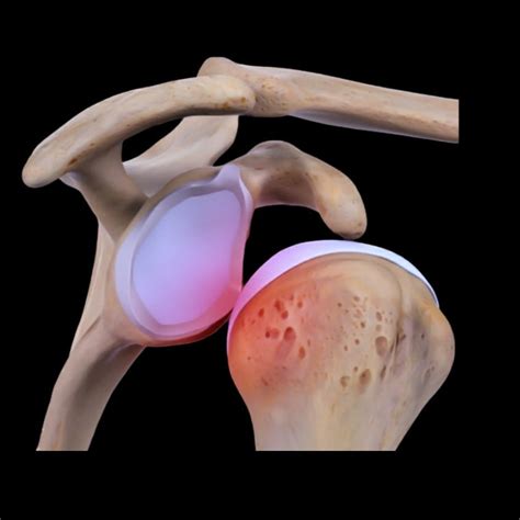 Arthroscopy Bankart repair for shoulder dislocation | Dr Sachin Jain Ortho