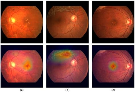 Interpretable Detection of Diabetic Retinopathy, Retinal Vein Occlusion ...