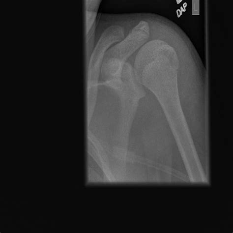 Bone Fracture Detection Using Image Processing Source Code GitHub 的图像结果