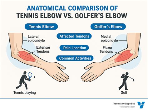 Golfer and Tennis Elbow: When Is Surgery Recommended? - Ventura Orthopedics