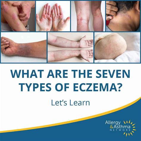 What is Eczema? - Allergy & Asthma Network