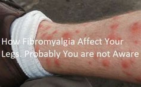 how is fibromyalgia causes