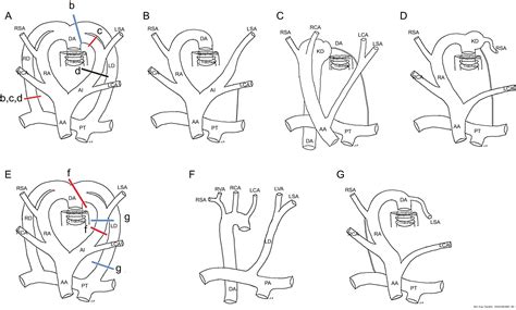 Right Aortic Arch With Aberrant Left Subclavian