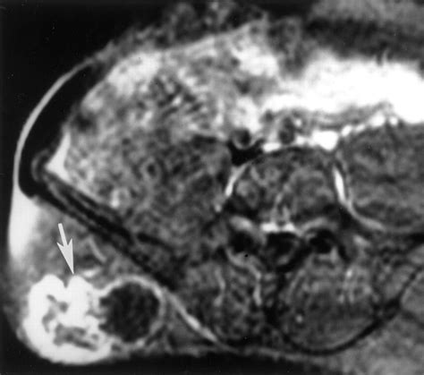 Cross-Sectional Imaging of Peripheral Nerve Sheath Tumors Characteristic Signs on CT, MR Imaging ...