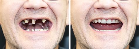 Image result for Immediate Dentures Procedure