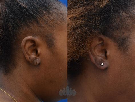Earlobe Repair Before and After Pictures Case 86 | Charlotte, NC | Dilworth Facial Plastic Surgery