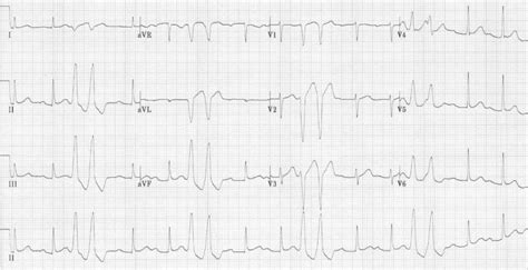 Image result for PVC ECG Reading