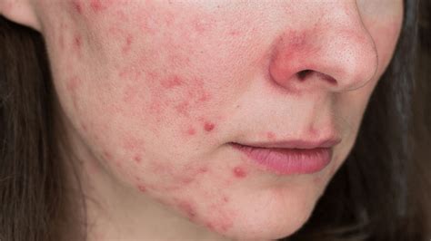 Papulopustular Rosacea: Symptoms & Treatments | Gladskin