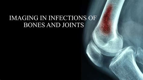 Imaging in infections of bones and joints2.pptx