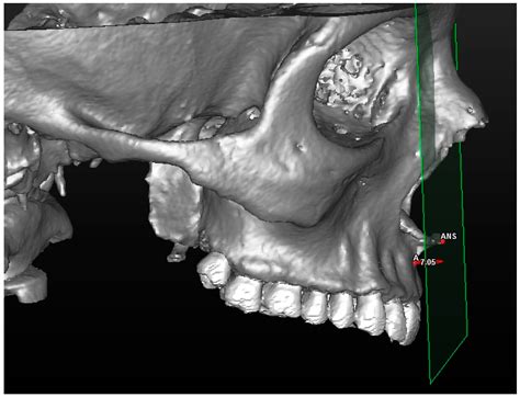 Novel Parameter in Pre-Surgical Orthodontic Preparation: A ...