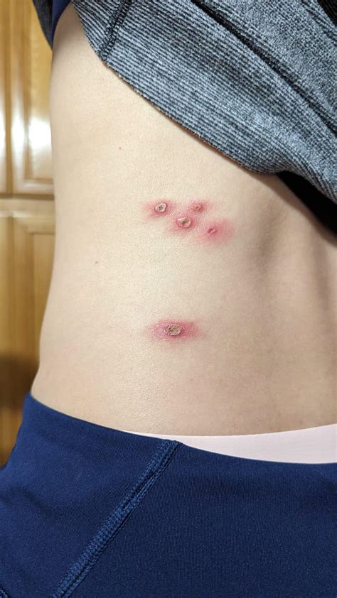 I would love some help. Rash that spread from torso onto back and arms over a period of two ...