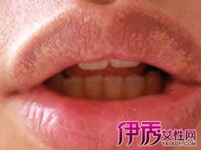【下唇内侧有小疙瘩】【图】为什么下唇内侧有小疙瘩呢 对于口腔你知道多少(2)_伊秀健康|yxlady.com