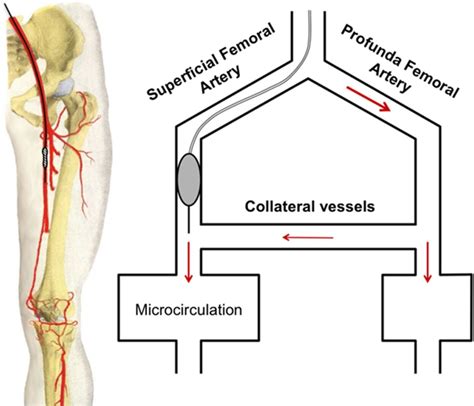 Direct Quantitative Assessment of the Peripheral Artery Collateral ...