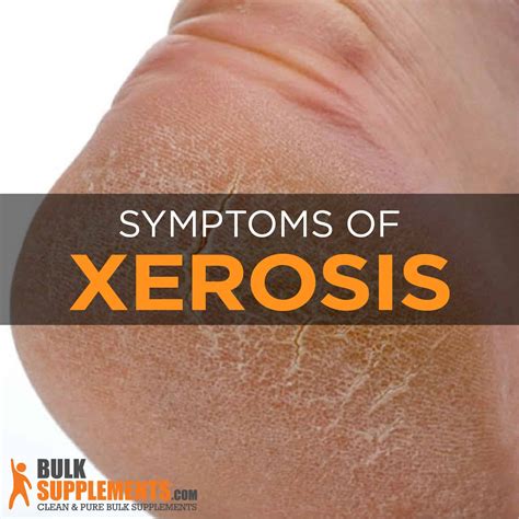 Xerosis Of Skin