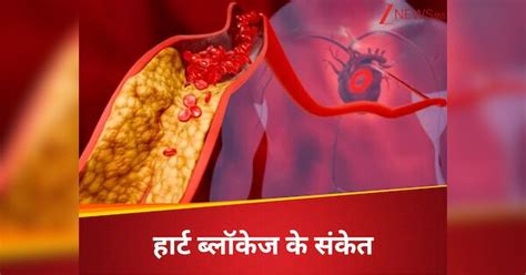 Plaque accumulating in arteries identify heart blockage without blood ...